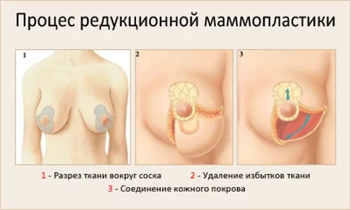 Грудь с имплантатами после родов