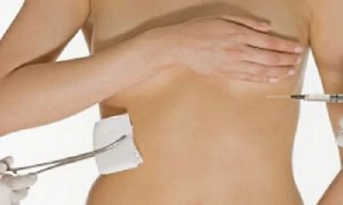 Удаление или замена грудных имплантов. О чем хотят знать женщины?